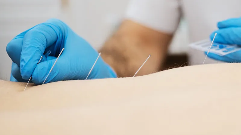 What Should You Expect from Acupuncture?