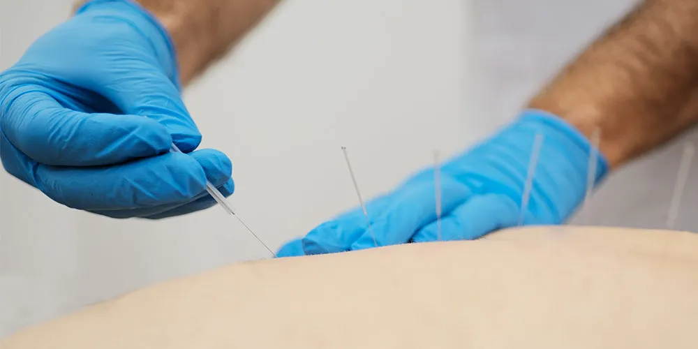 What is Acupuncture and What Does It Do?