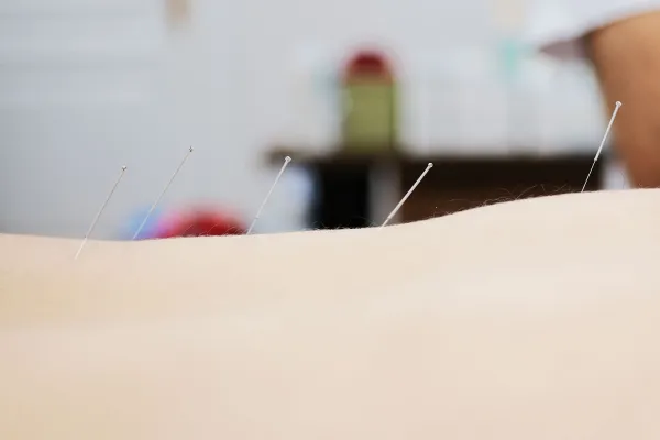 Akupunktur Nedir ve Ne İşe Yarar?