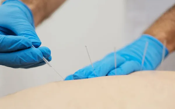 What is Acupuncture and What Does It Do?
