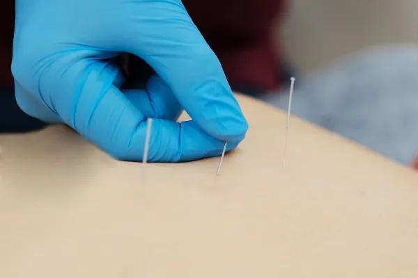 What is Dry Needle Treatment and How Is It Performed?